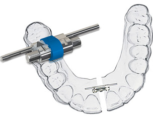 Expansionsbehandlung mit Vector 40