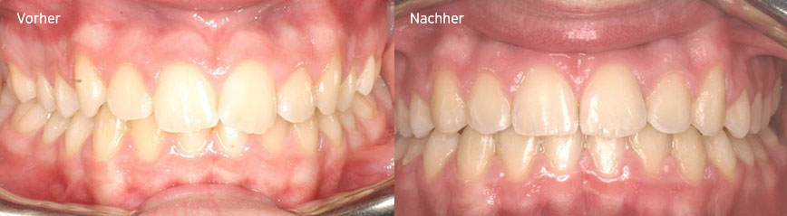Vorher, nachher
